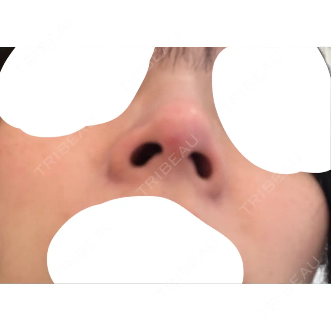 鼻尖形成（切開） / 軟骨移植 / 鼻尖縮小 ASTRA BEAUTY CLINIC AFTER