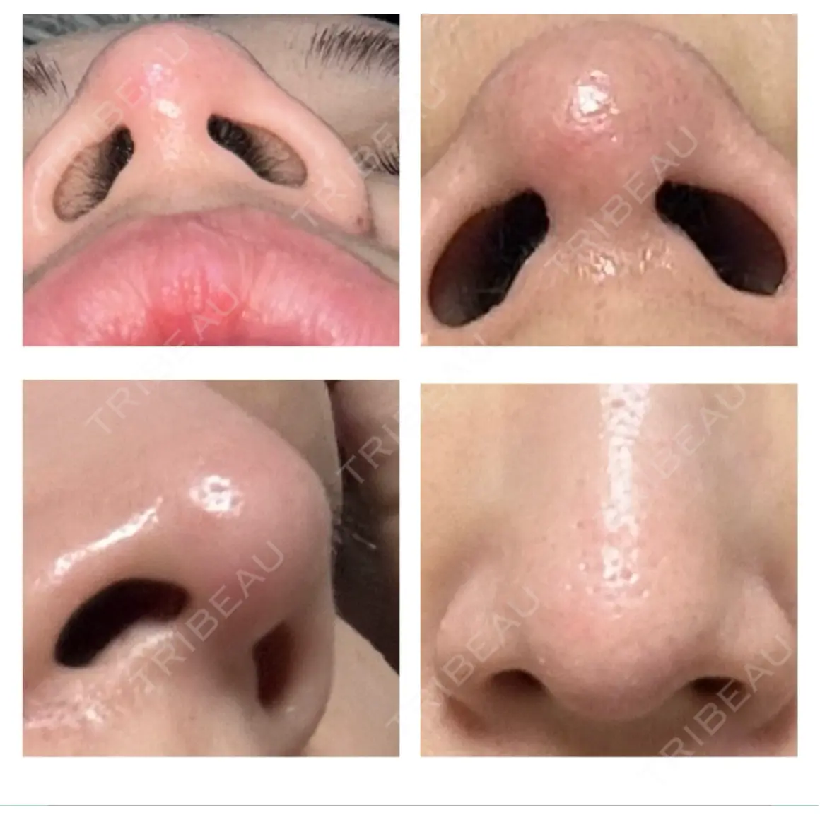 鼻尖形成（切開） / 軟骨移植 / 鼻尖縮小 ASTRA BEAUTY CLINIC AFTER