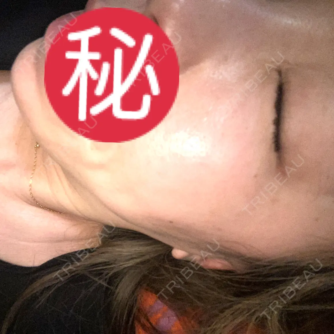 ヒアルロン酸注入（鼻） / ヒアルロン酸注入（唇） / ボトックス（目尻） HAAB×DREAM BEAUTY CLINIC 大阪梅田院 AFTER