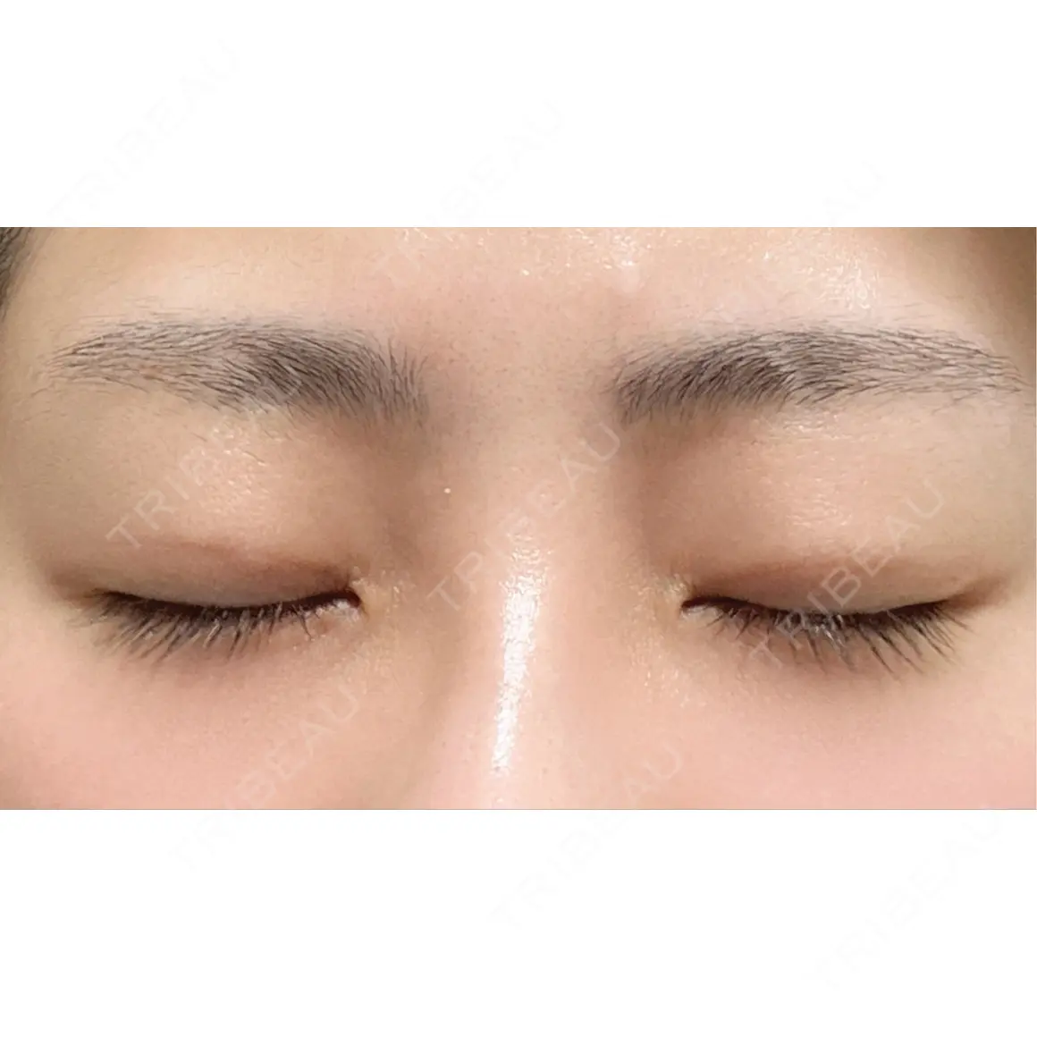 二重埋没 オアシス美容外科 AFTER