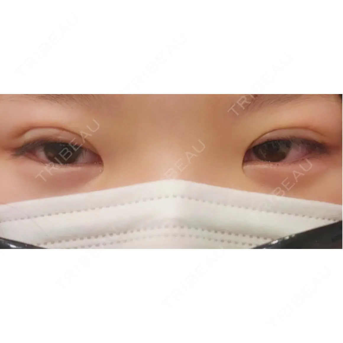 二重埋没 湘南美容クリニック 千葉センシティ院 DAY 1