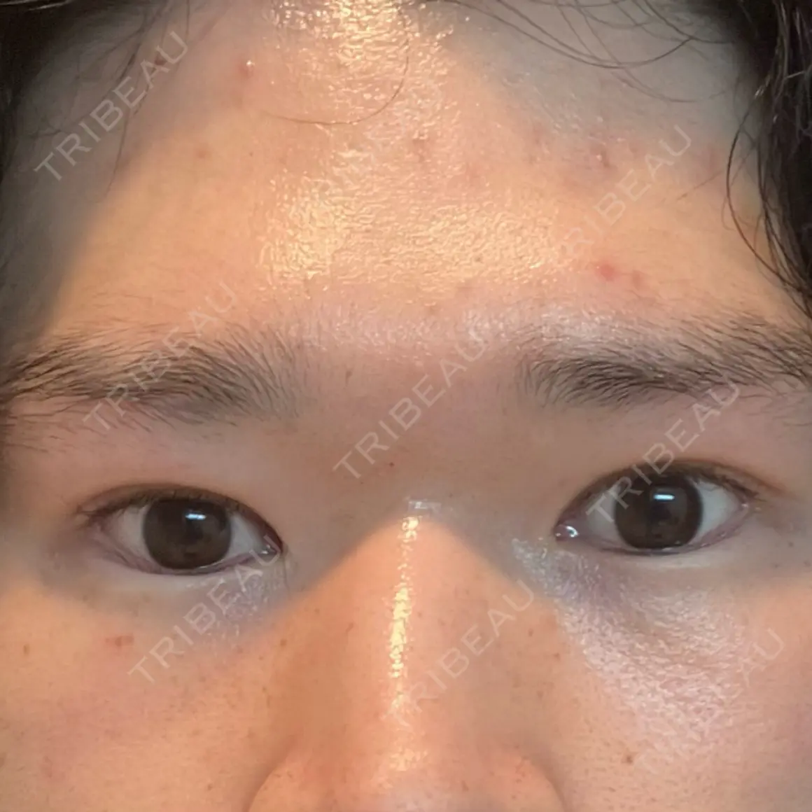 二重切開 / 眼瞼下垂（切開） / 下まぶたたるみ取り / 目元修正 WOM CLINIC GINZA （ワム クリニック ギンザ） AFTER