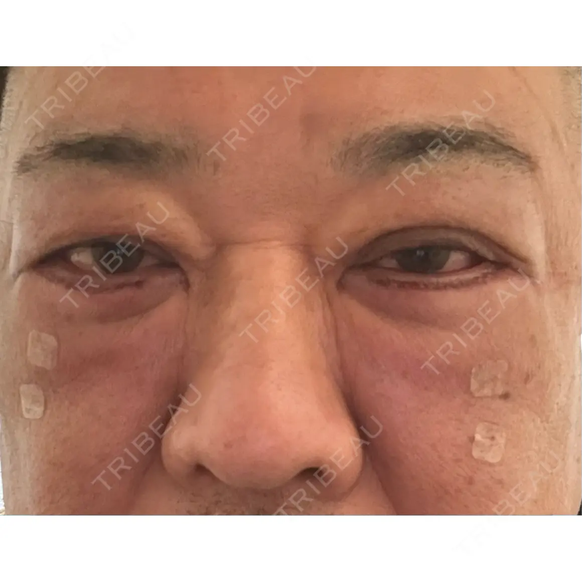 下まぶたの脂肪取り 湘南美容クリニック 千葉センシティ院 DAY 0