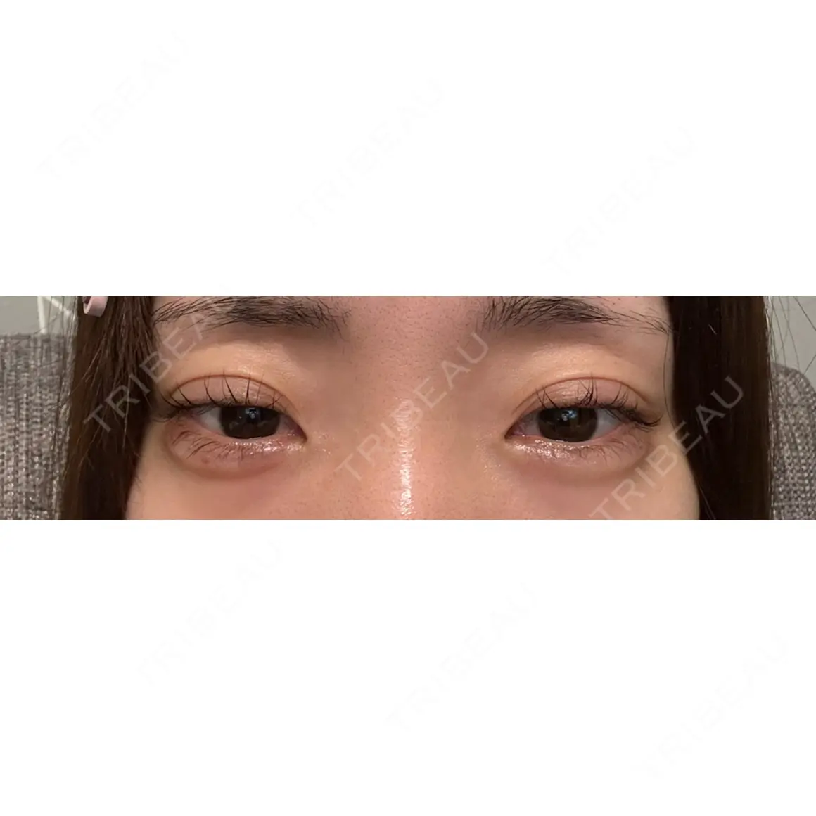 ヒアルロン酸注入（涙袋） 新未来クリニック AFTER