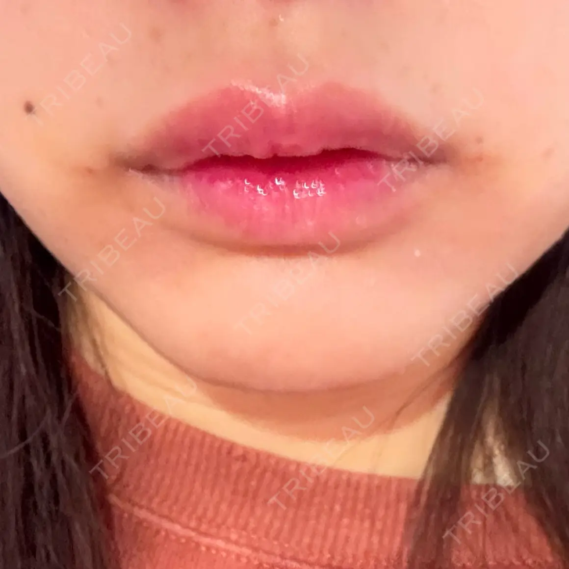 ヒアルロン酸注入（涙袋） / ヒアルロン酸注入（唇） / ボトックス（ガミースマイル） / その他（鼻） THE FIRST CLINIC 町田院 AFTER