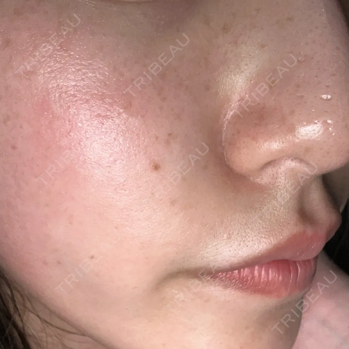 肌ヒアルロン酸注入（たるみ・シワ改善） Code Beauty Clinic 名古屋院 AFTER