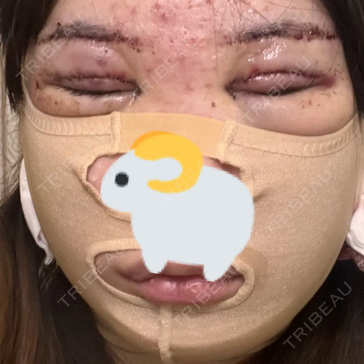 目頭切開 / 眼瞼下垂（切開） / 糸リフト / 脂肪吸引（顔） / 上まぶたの脂肪取り / 眉下切開 / ジョールファット除去 / ボトックス（額） Otus Clinic 【オータスクリニック】 DAY 0