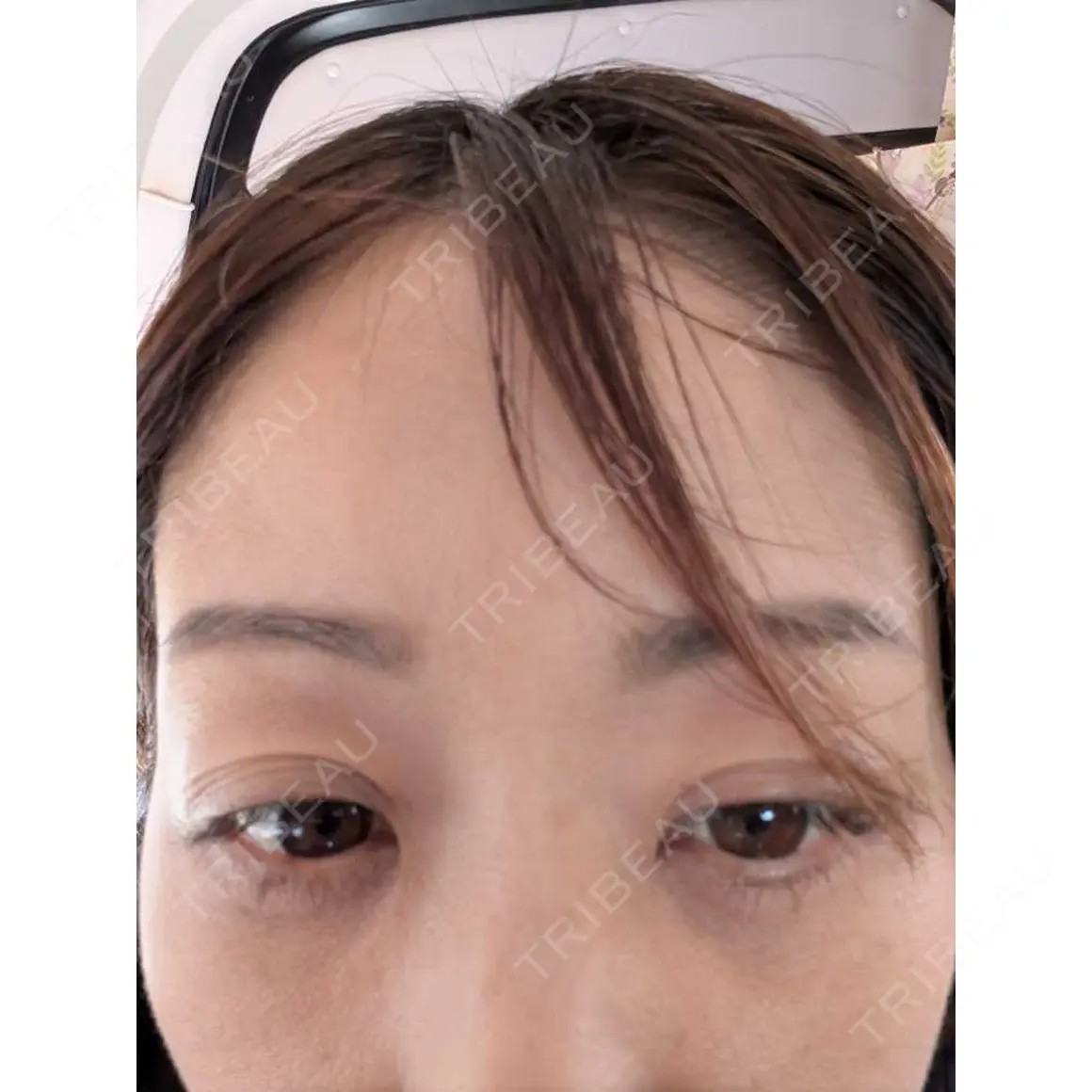 クマ治療 東京BELLEZZAクリニック AFTER
