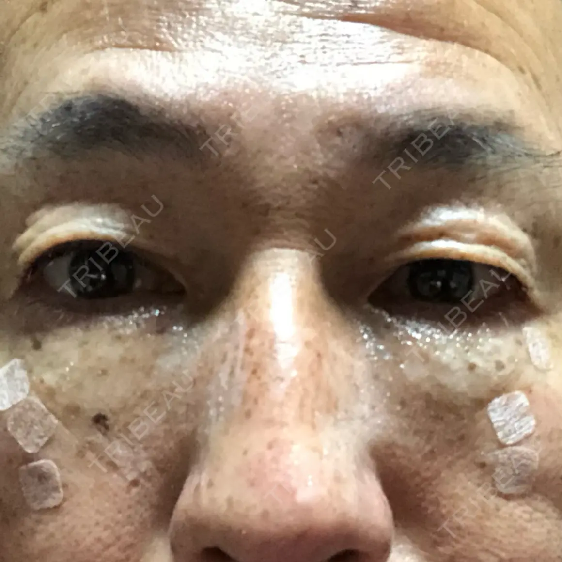 クマ治療 湘南美容クリニック 千葉センシティ院 DAY 0