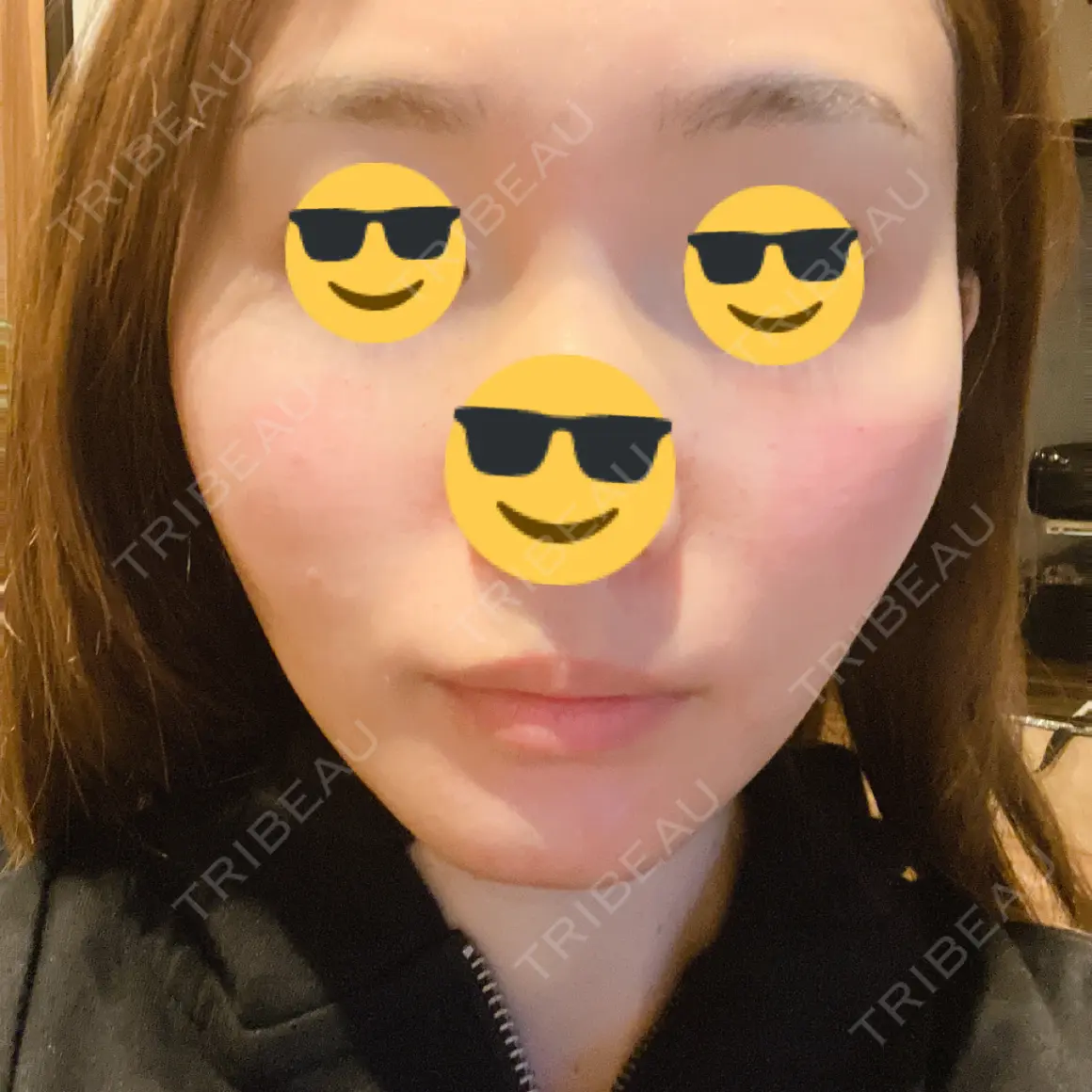水光注射（ハリ・美肌） Re:anne clinic 銀座 【リアンクリニック銀座】 DAY 0
