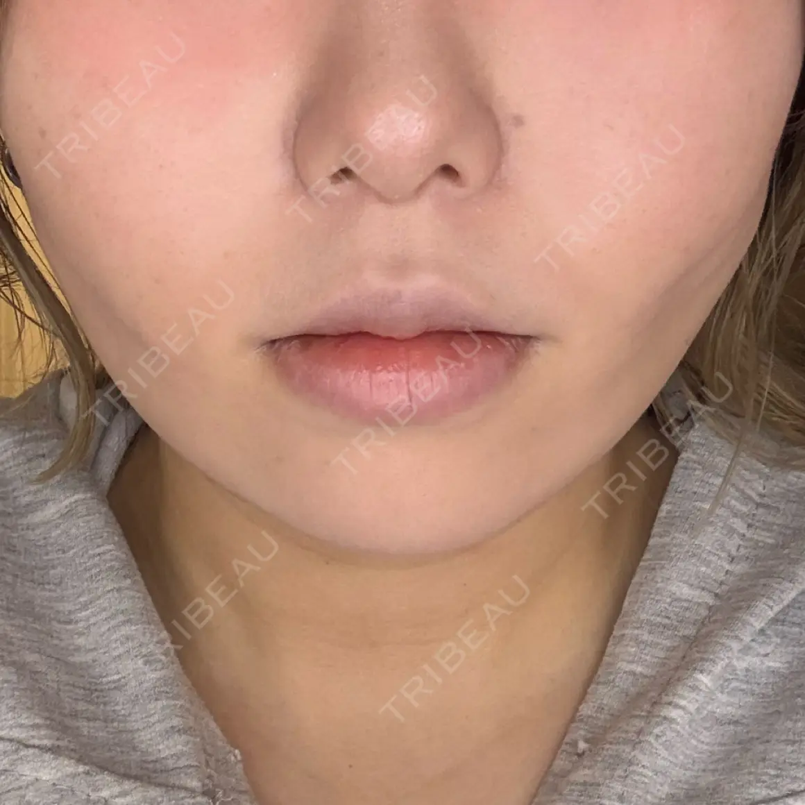 イオン導入 / ピーリング（ハリ・ツヤ） / ルメッカ ルラ美容クリニック 仙台院 / ルラスキンクリニック 仙台院 AFTER