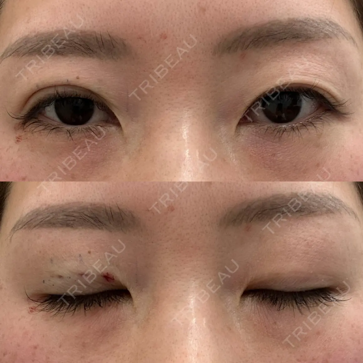 二重埋没 湘南美容クリニック 枚方院 DAY 0