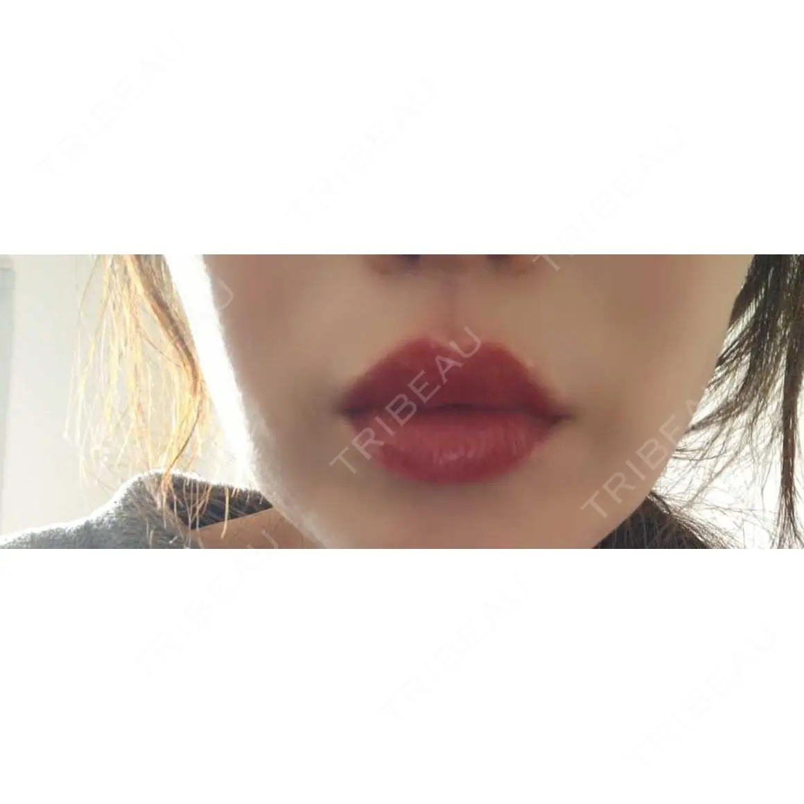 ヒアルロン酸注入（唇） AZ BEAUTY CLINIC DAY 2