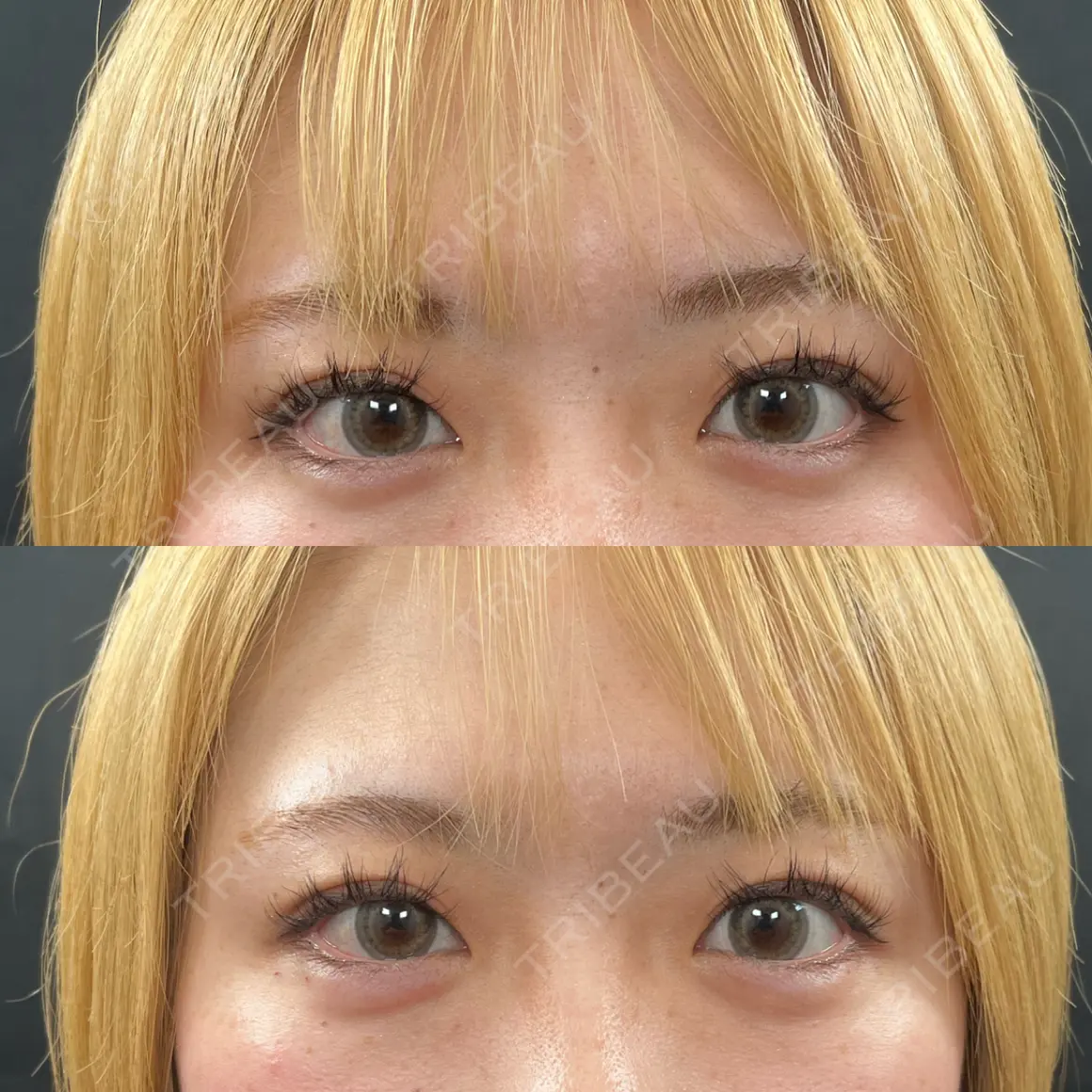 ヒアルロン酸注入（涙袋） THE FIRST CLINIC 町田院 AFTER