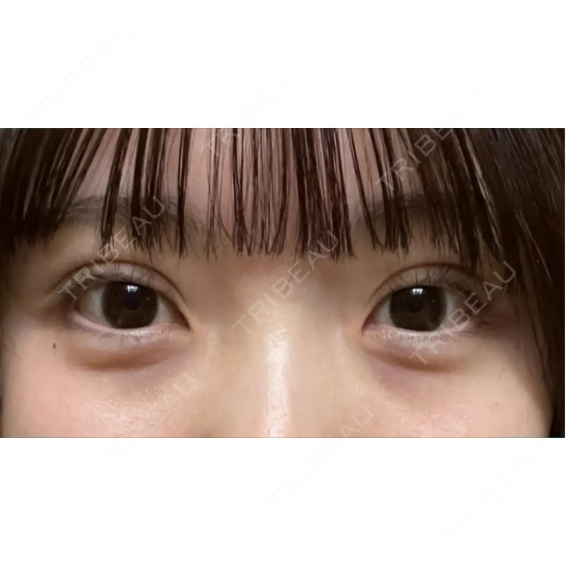 二重埋没 湘南美容クリニック 池袋東口院 DAY 0