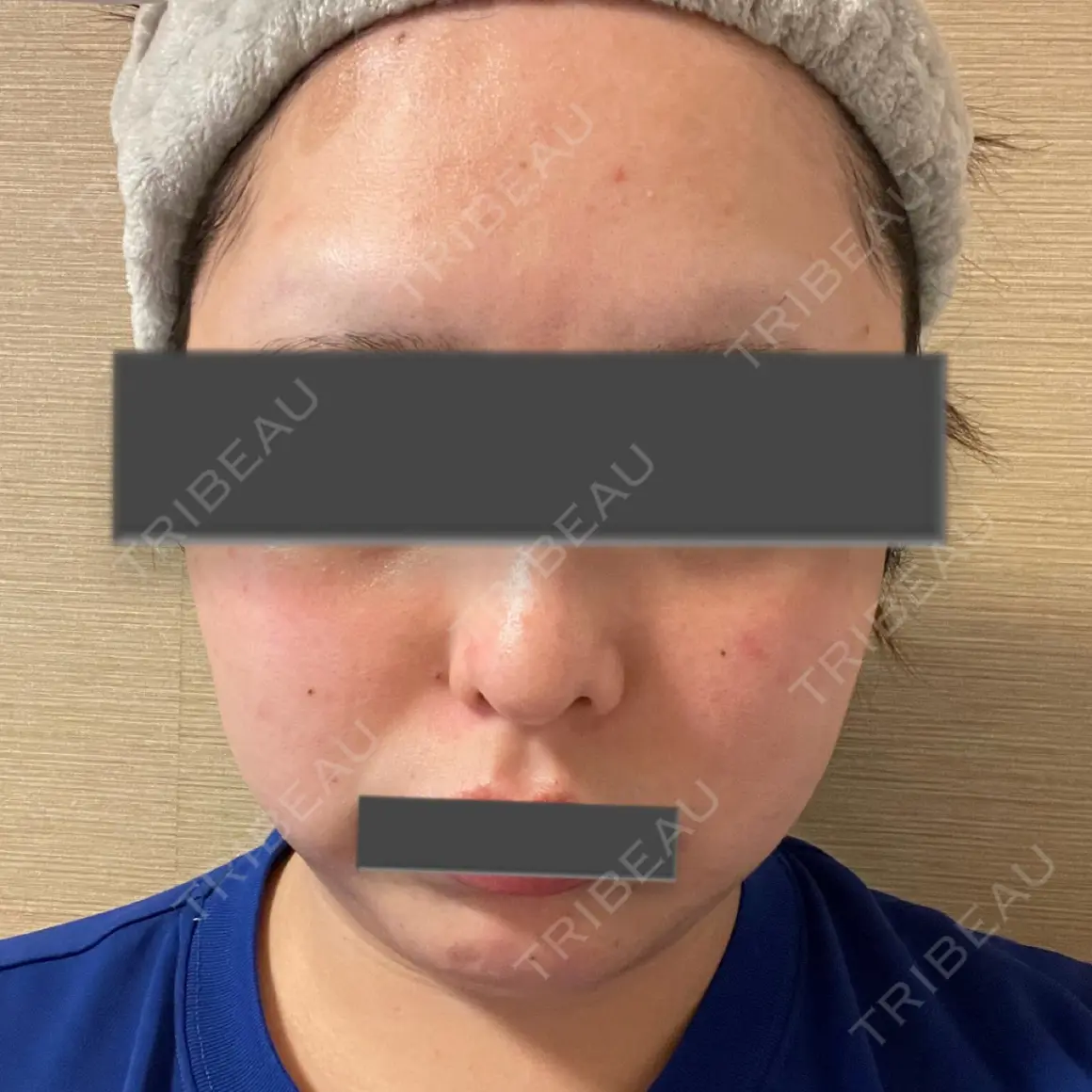 ヴェルヴェットスキン ブルームクリニック（BLOOM CLINIC） AFTER