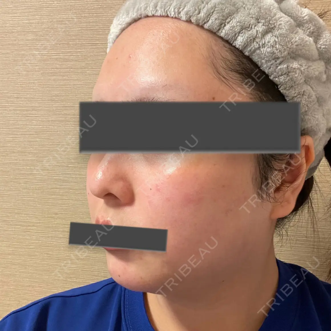 ヴェルヴェットスキン ブルームクリニック（BLOOM CLINIC） AFTER