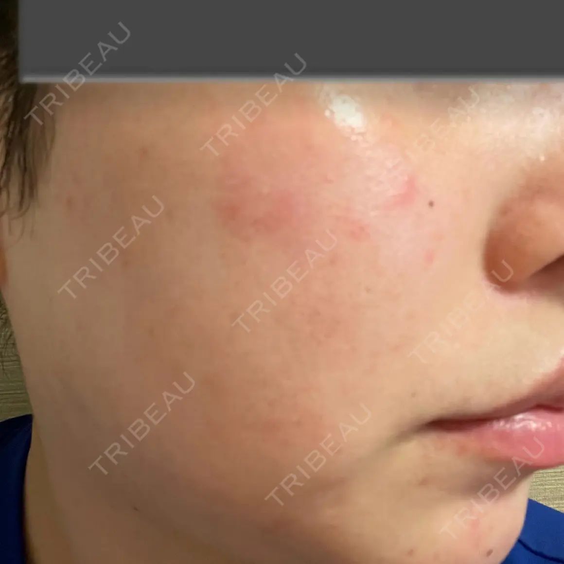 ヴェルヴェットスキン ブルームクリニック（BLOOM CLINIC） AFTER