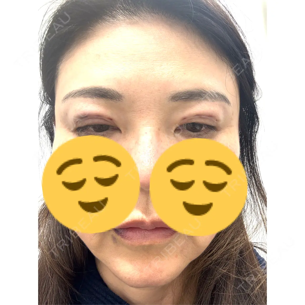 二重埋没 / 目元修正 BELINDA CLINIC（ベリンダクリニック）岡山院 DAY 0