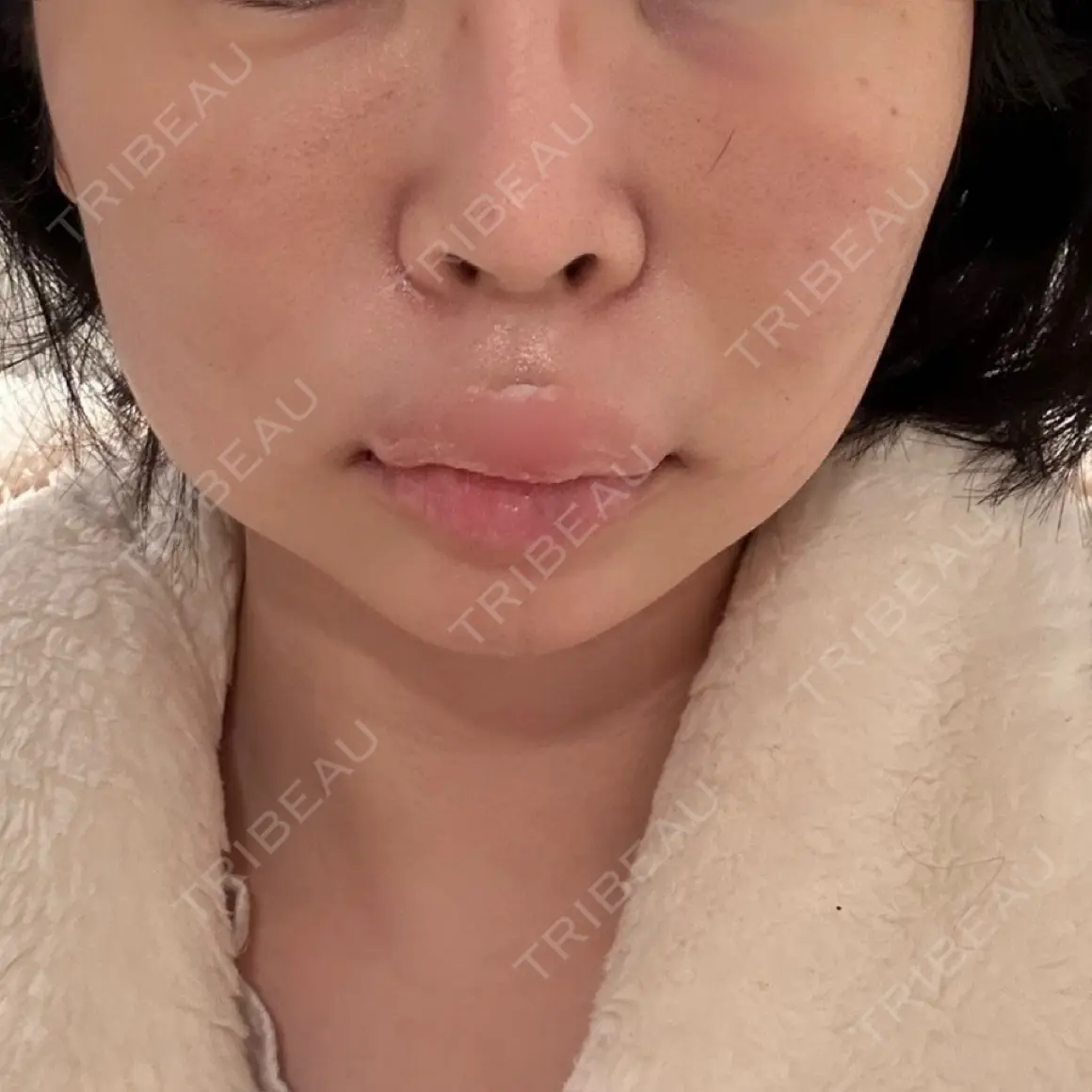 バッカルファット除去 / メーラーファット除去 藤・ナチュレ美容クリニック 銀座院 DAY 1