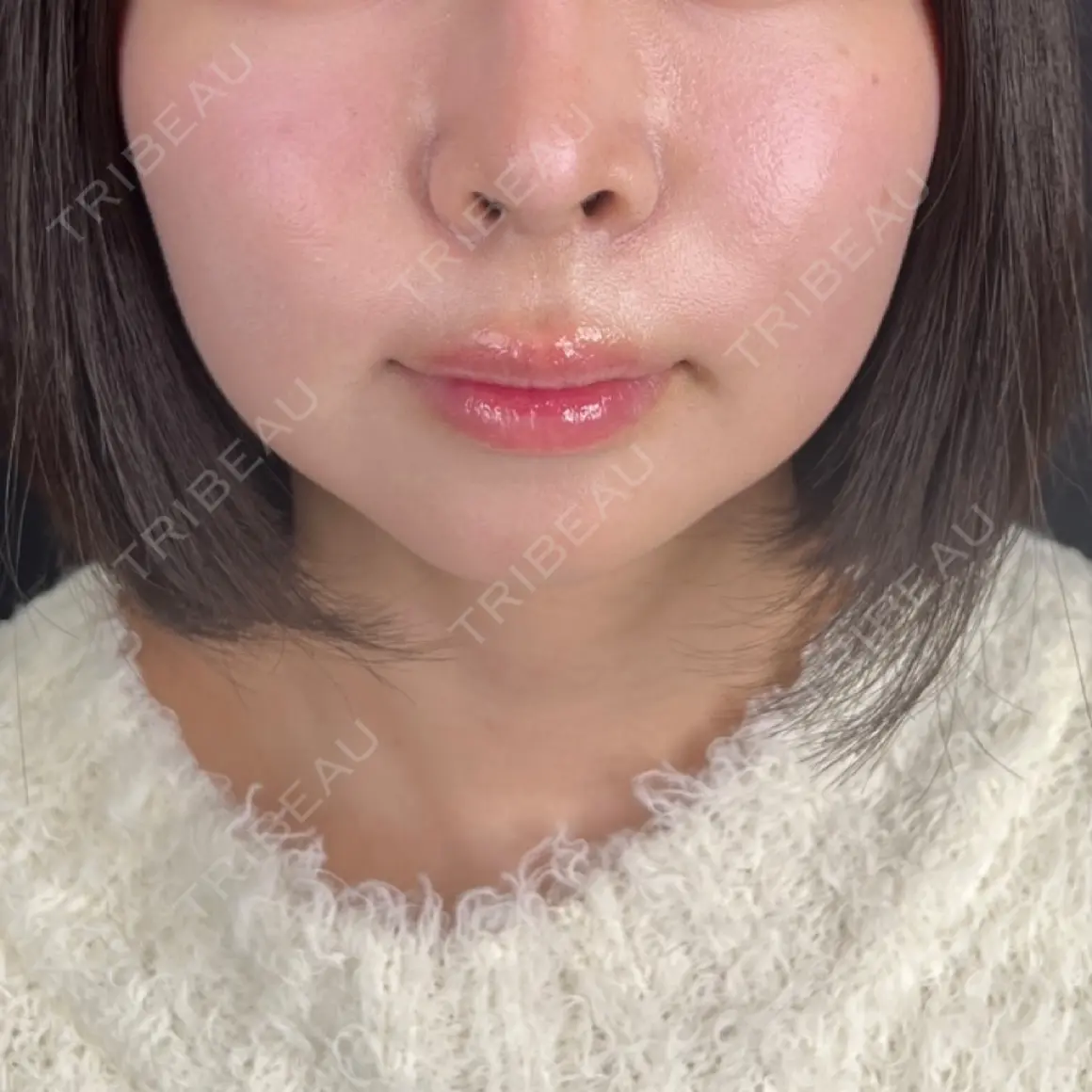 バッカルファット除去 / メーラーファット除去 藤・ナチュレ美容クリニック 銀座院 AFTER