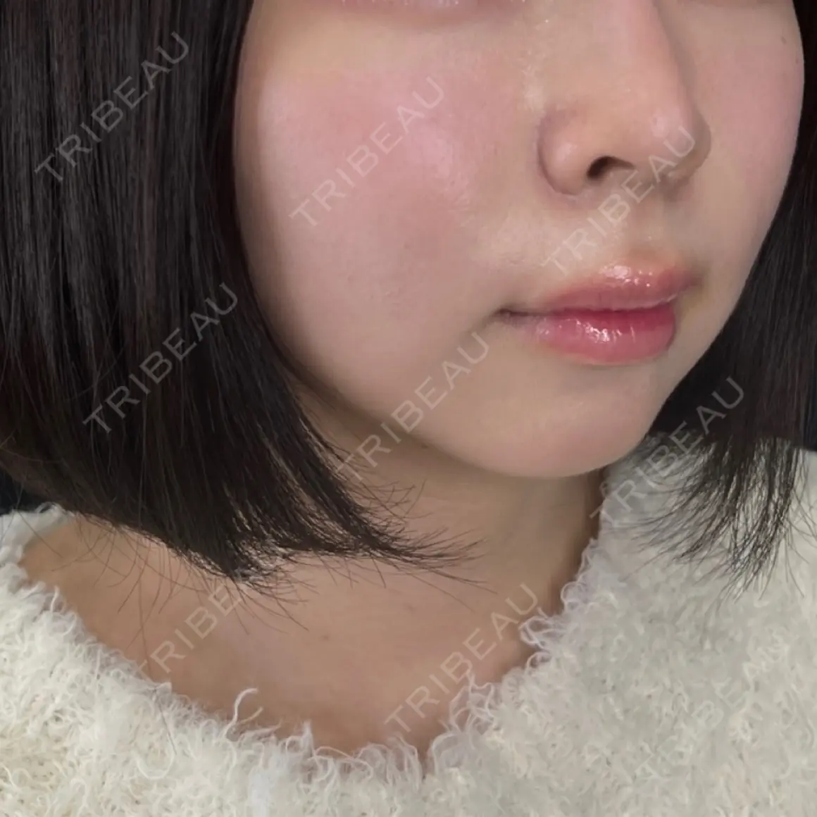 バッカルファット除去 / メーラーファット除去 藤・ナチュレ美容クリニック 銀座院 AFTER