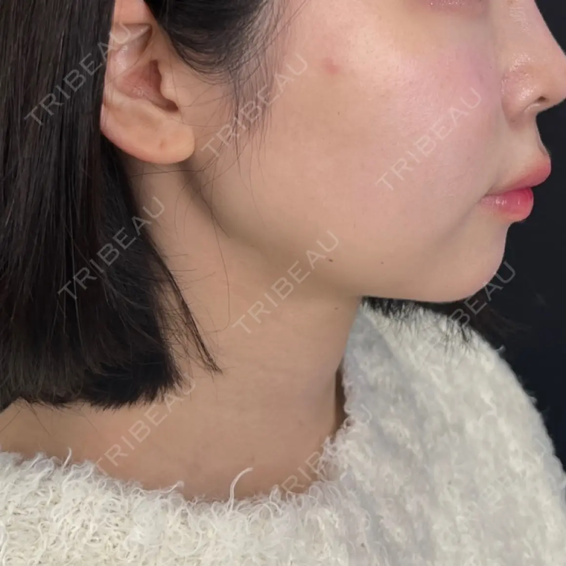 バッカルファット除去 / メーラーファット除去 藤・ナチュレ美容クリニック 銀座院 AFTER