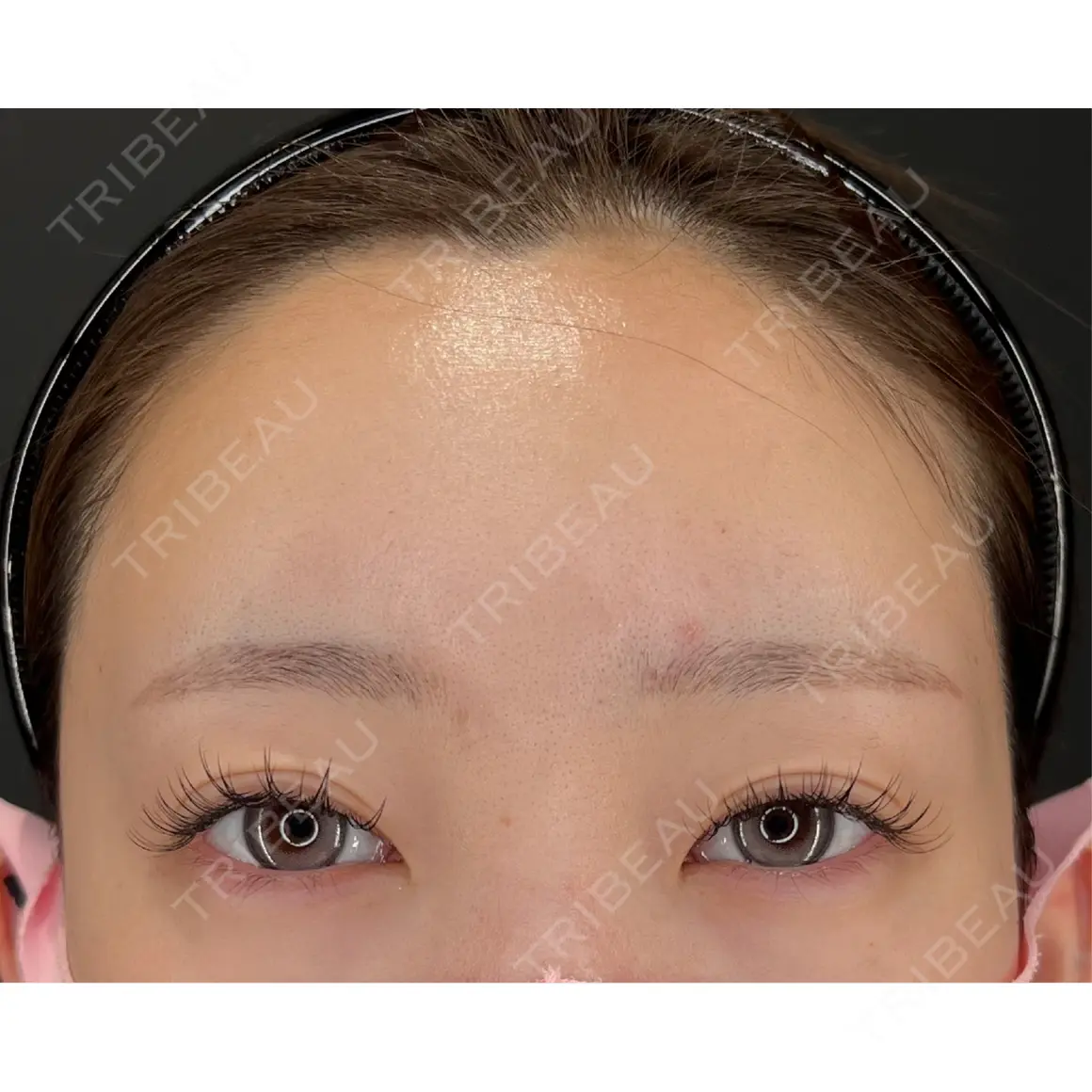 脂肪注入（額） HAAB×DREAM BEAUTY CLINIC 大阪梅田院 AFTER