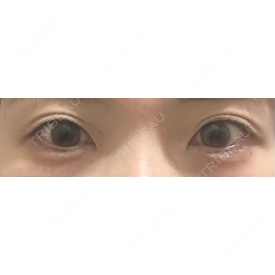 ヒアルロン酸注入（涙袋） / ヒアルロン酸注入（唇） 銀座美容外科クリニック 銀座院 DAY 0