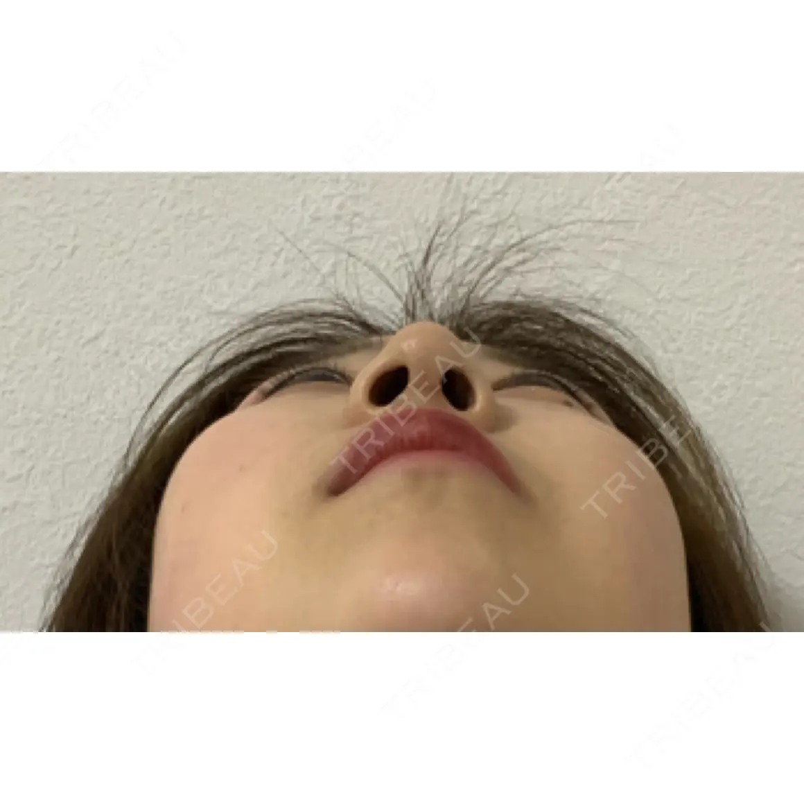 隆鼻術 / 鼻尖形成（切開） / 鼻中隔延長（切開） リエンジャン整形外科 江南店 AFTER