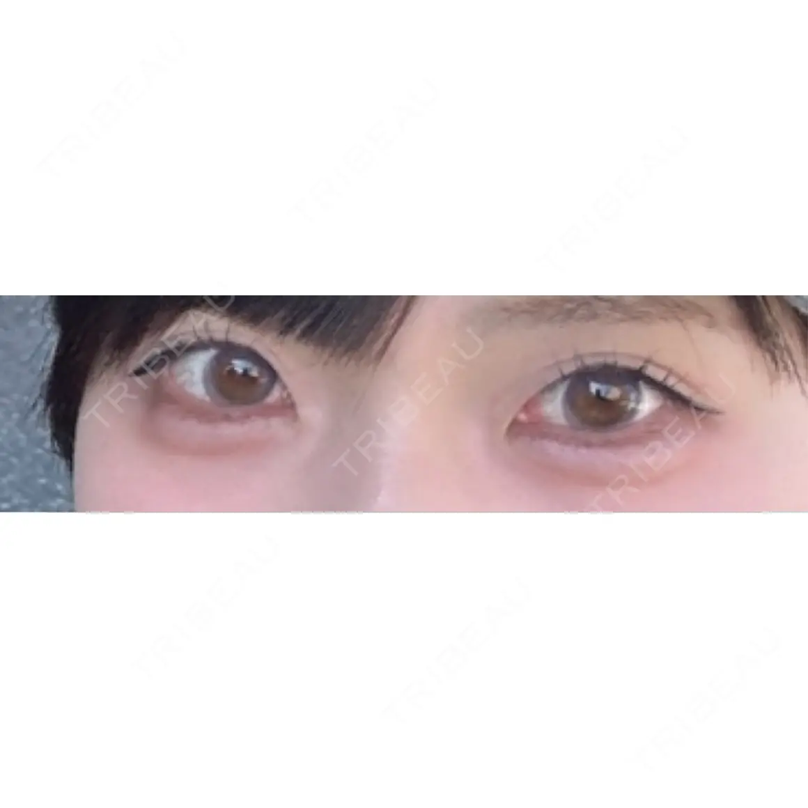 ヒアルロン酸注入（涙袋） / ヒアルロン酸注入（唇） 銀座美容外科クリニック 銀座院 AFTER