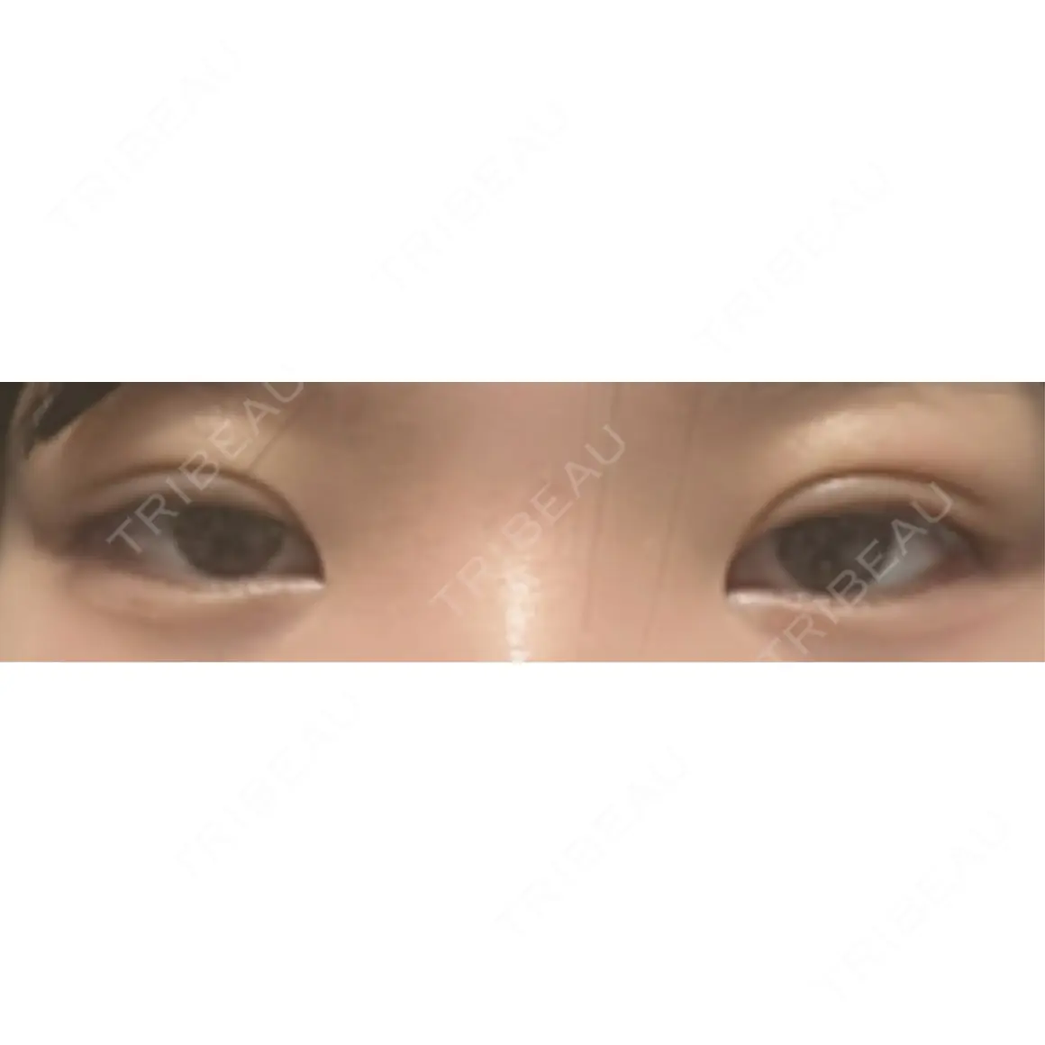二重埋没 湘南美容クリニック 千葉センシティ院 AFTER