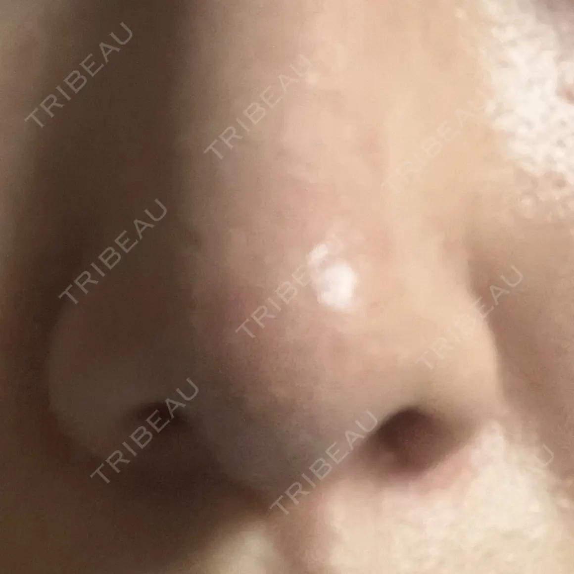 鼻尖形成（切開） / 鼻中隔延長（切開） / 軟骨移植 / 眉間プロテーゼ / 鼻柱下降・鼻唇角形成（猫手術） 湘南美容クリニック 新宿本院 AFTER