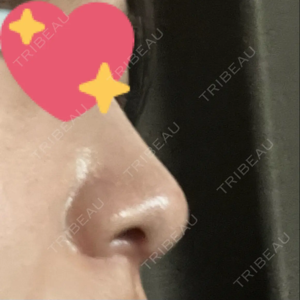 鼻尖形成（切開） / 鼻中隔延長（切開） / 軟骨移植 / 眉間プロテーゼ / 鼻柱下降・鼻唇角形成（猫手術） 湘南美容クリニック 新宿本院 AFTER