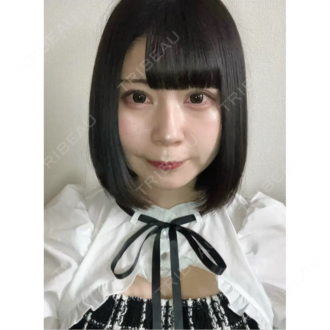 二重埋没 / 上まぶたの脂肪取り 藤・ナチュレ美容クリニック 銀座院 AFTER