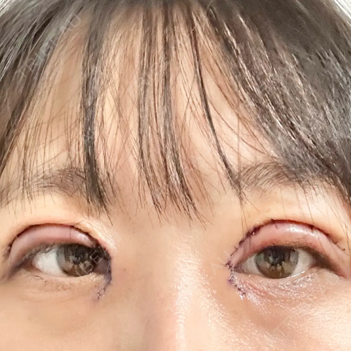 二重切開 / 目頭切開 銀座S美容・形成外科クリニック DAY 0