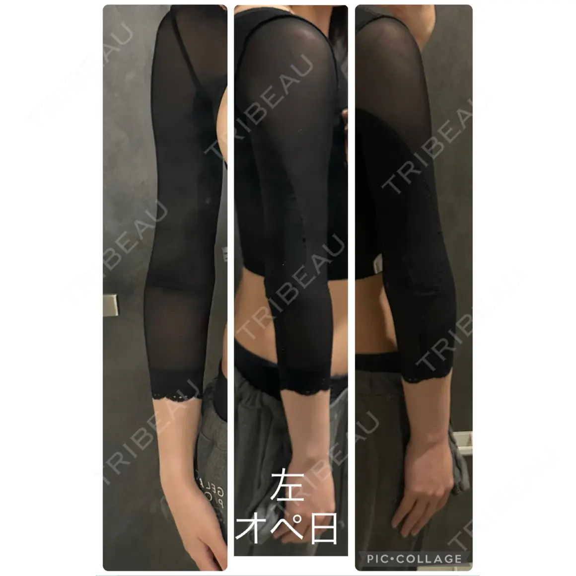 脂肪吸引（二の腕） オアシス美容外科 DAY 0