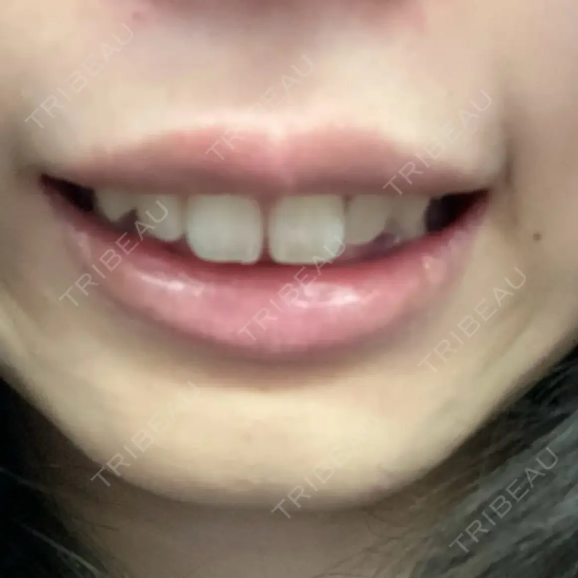 ボトックス（ガミースマイル） ブルームクリニック（BLOOM CLINIC） AFTER