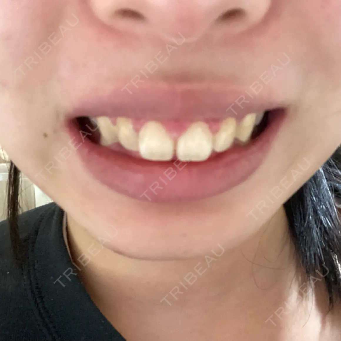 ボトックス（ガミースマイル） ブルームクリニック（BLOOM CLINIC） AFTER
