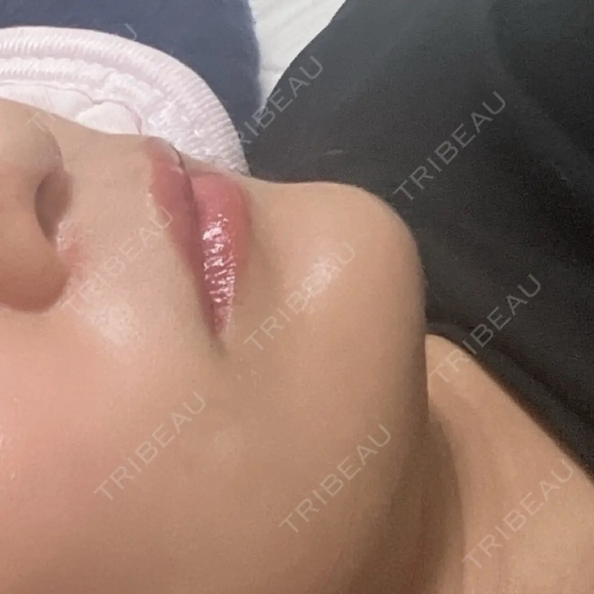 ヒアルロン酸注入（あご） HAAB×DREAM BEAUTY CLINIC 東京本院 AFTER