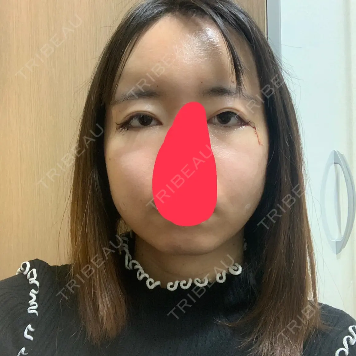 糸リフト / 目尻切開 / タレ目形成・グラマラスライン（切開） / 脂肪注入（額） / 脂肪注入（輪郭） LUHO（ルホ）美容外科 DAY 0