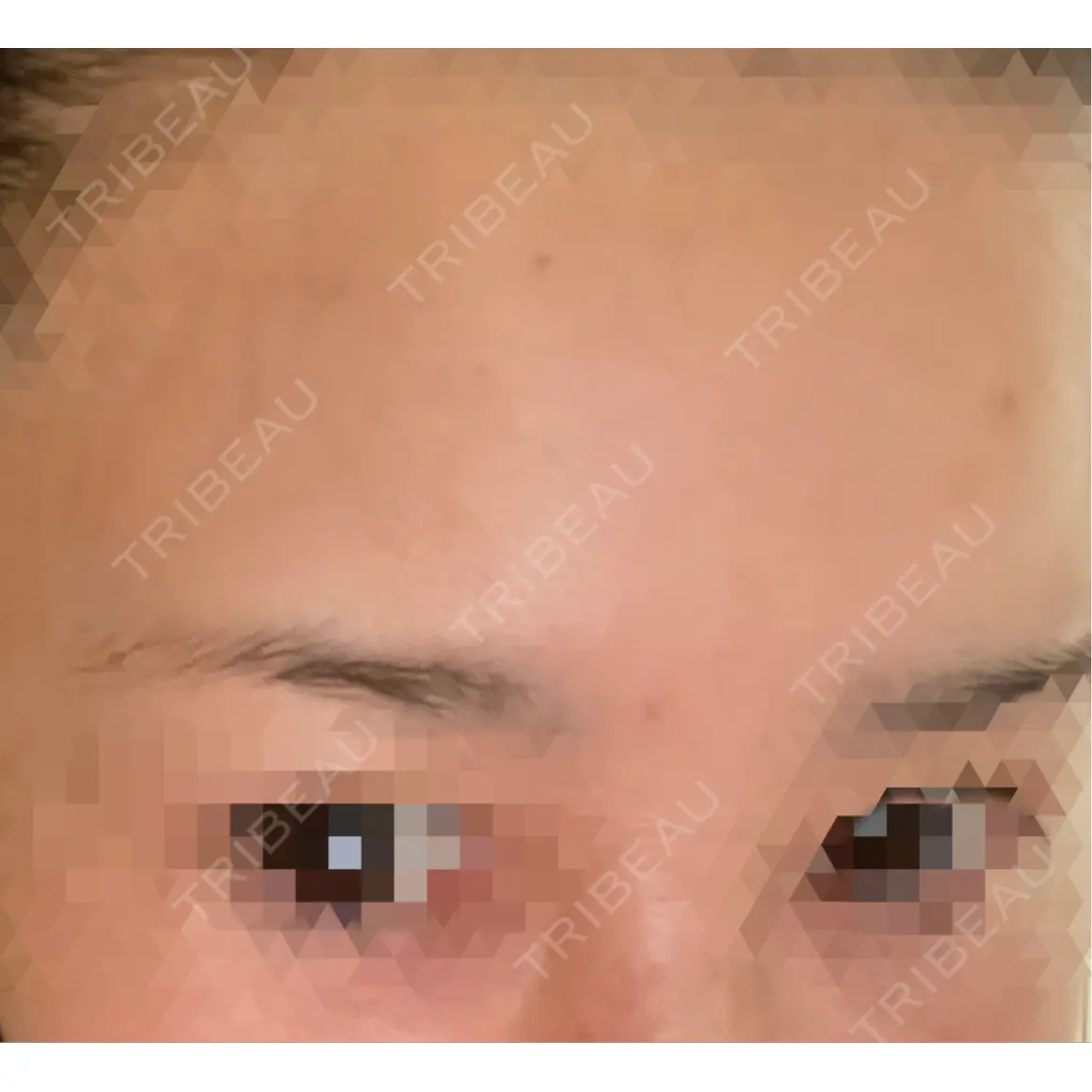 白玉点滴・注射 / シワ取りボトックス シン・整形外科 綱島 AFTER