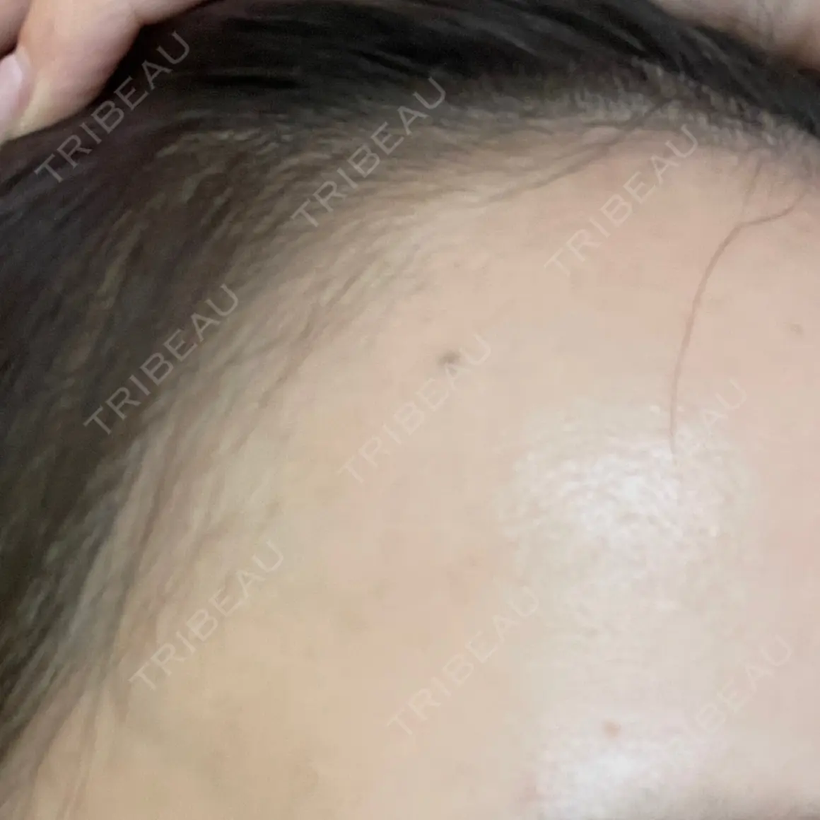 アートメイク（ヘアライン） Tokyo Tensei Clinic 新宿院 AFTER