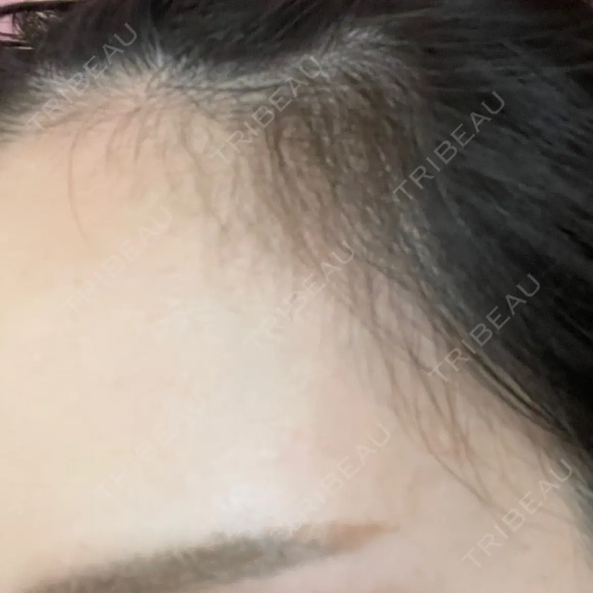 アートメイク（ヘアライン） Tokyo Tensei Clinic 新宿院 AFTER