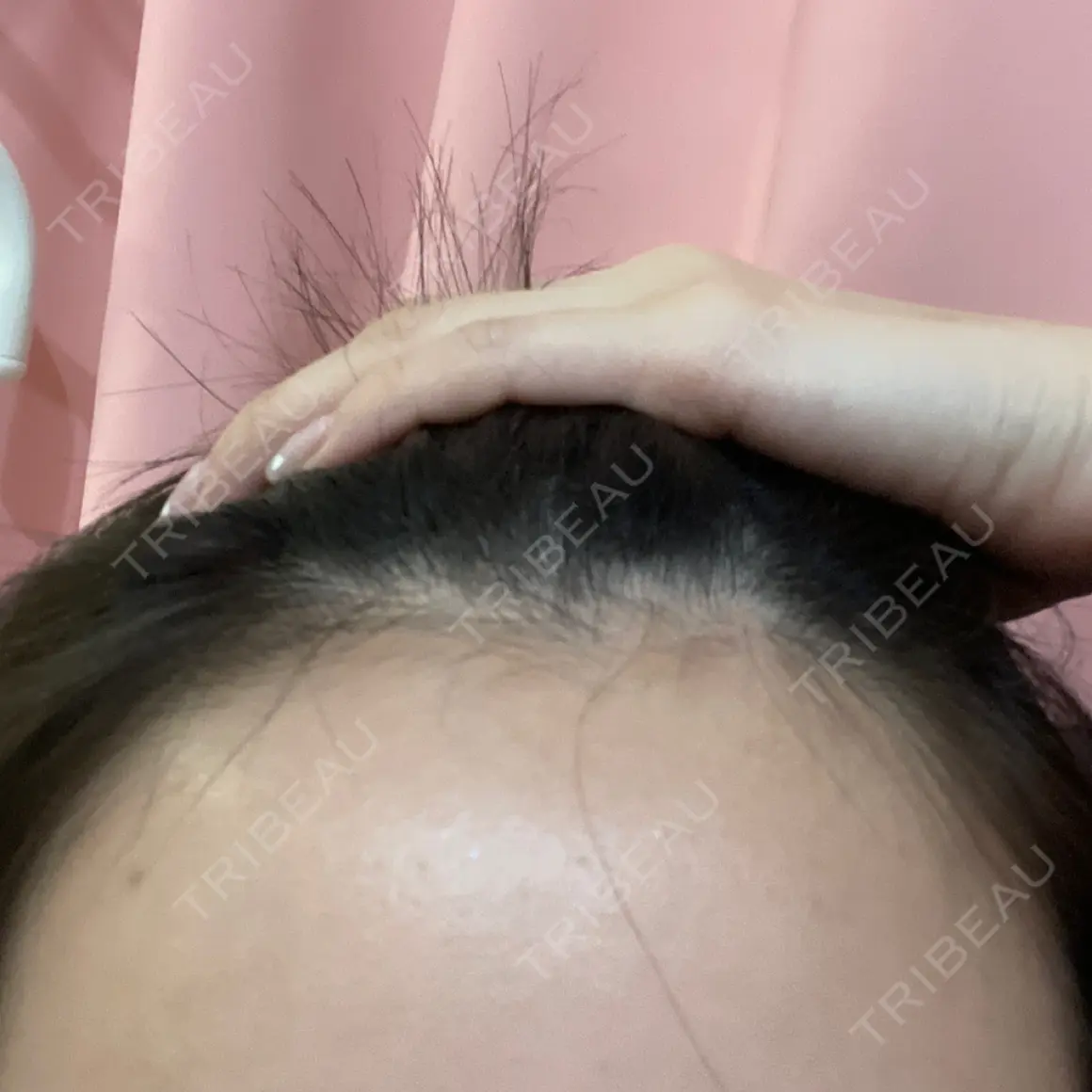 アートメイク（ヘアライン） Tokyo Tensei Clinic 新宿院 AFTER