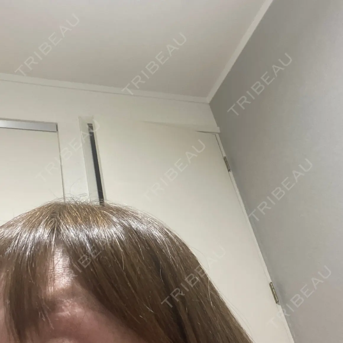 ボトックス（眉間） / ボトックス（目尻） / その他（鼻） TCB東京中央美容外科 前橋院 AFTER