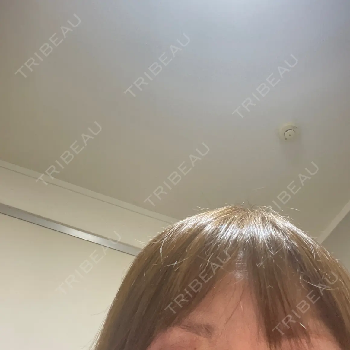 ボトックス（眉間） / ボトックス（目尻） / その他（鼻） TCB東京中央美容外科 前橋院 AFTER