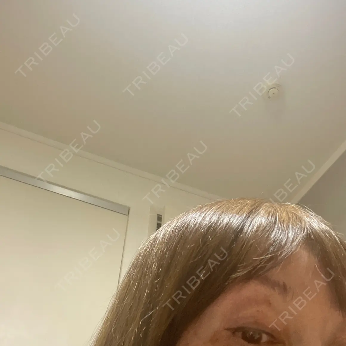 ボトックス（眉間） / ボトックス（目尻） / その他（鼻） TCB東京中央美容外科 前橋院 AFTER