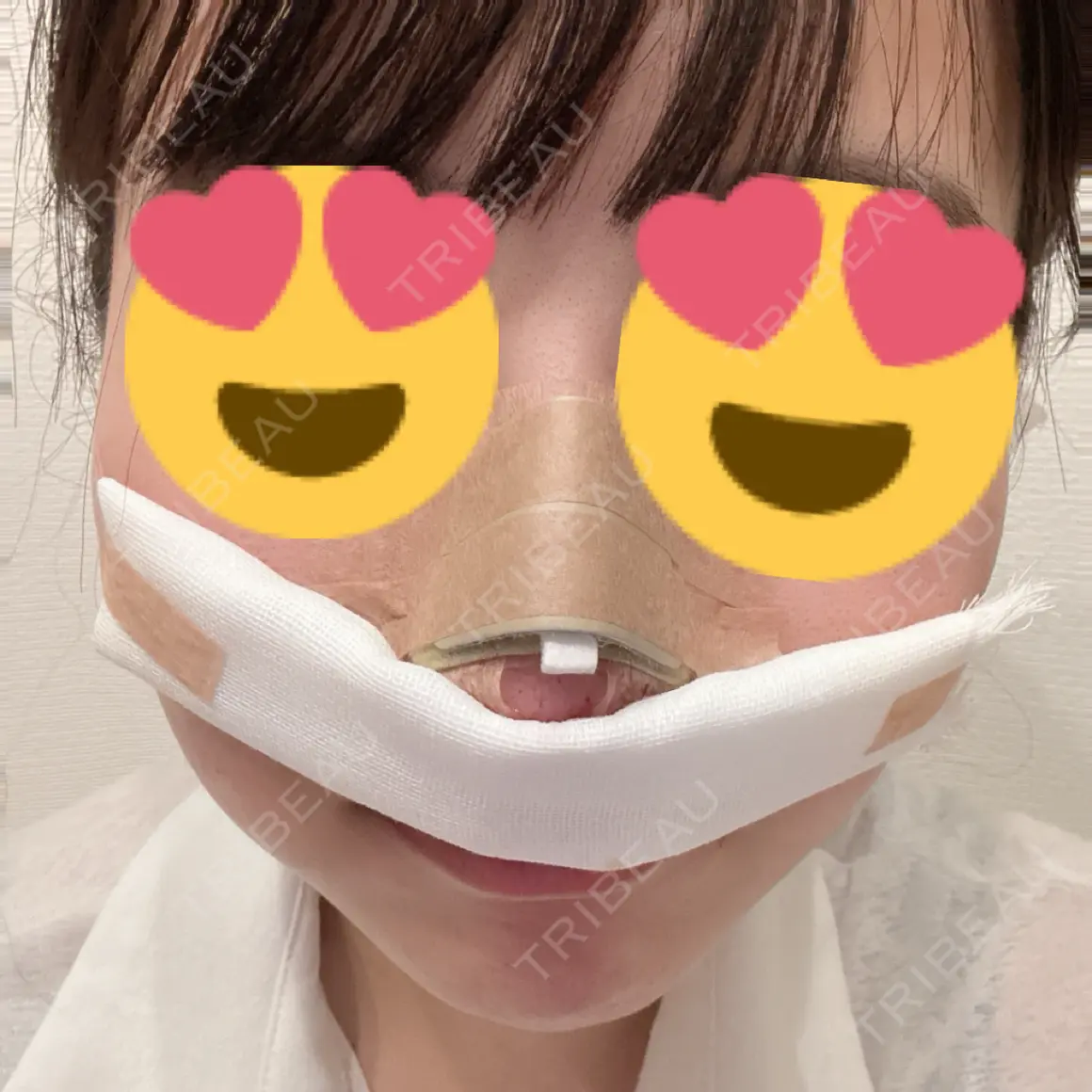 鼻尖形成（切開） / 小鼻縮小（切開） / 軟骨移植 / 毛穴洗浄（ハイドラフェイシャルなど） / その他（鼻） KARIS beauty clinic DAY 0