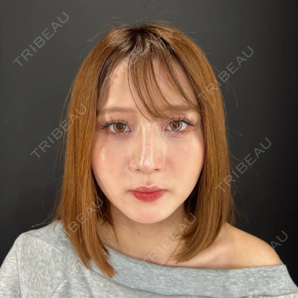 二重埋没 / 目頭切開 / 糸リフト / ヒアルロン酸注入（涙袋） / ヒアルロン酸注入（鼻） / ヒアルロン酸注入（あご） / ヒアルロン酸注入（唇） HAAB×DREAM BEAUTY CLINIC 大阪梅田院 AFTER